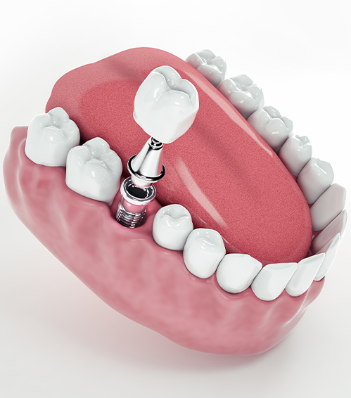 dentreal_meram_implant