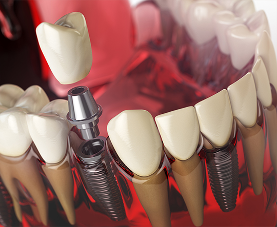 Konya implant tedavisi - DentReal Meram diş kliniği uygulamaları