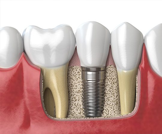 Konya çene kemiğine implant yerleştirme işlemi görseli