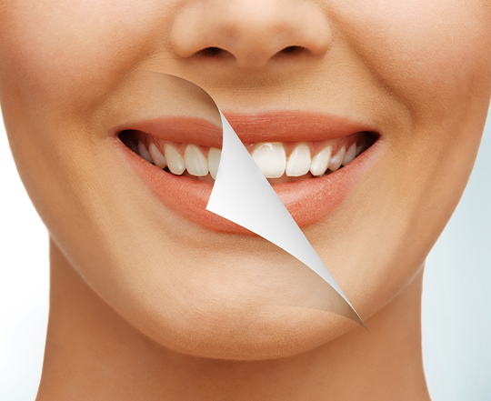 Dentreal Meram Konya diş beyazlatma bleaching uygulaması