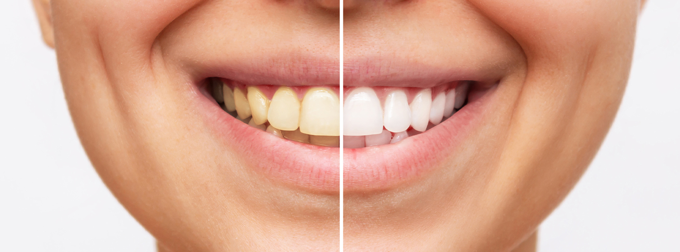 Konya diş beyazlatma öncesi ve sonrası sonuçları DentReal Meram